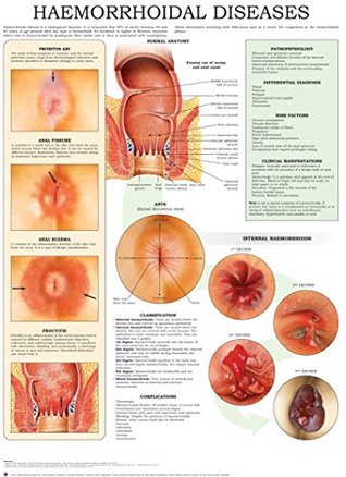Download Haemorrhoidal Diseases e-chart: Quick reference guide - HC-HealthComm | PDF
